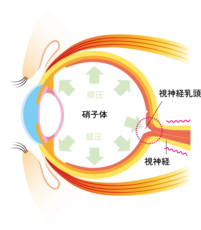 緑内障の眼球